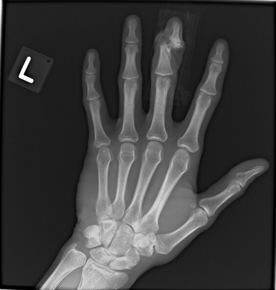 An X-ray of Airman 1st Class Daniel Cherry's left hand depicts where his middle finger was nearly sliced in two by a 4,000 pound pallet. Cherry, a C-17 Globemaster III loadmaster deployed from Charleston Air Force Base, S.C., was loading cargo onto an aircraft when his finger became stuck on a D-ring and was nearly amputated between a pallet and loading rail. (courtesy photo)