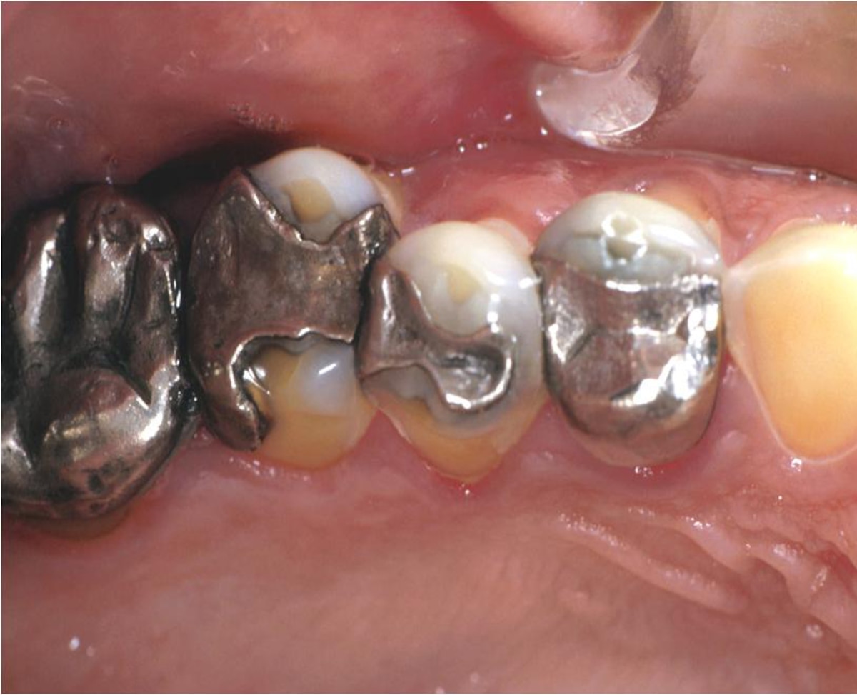 causes of tooth decay in adults