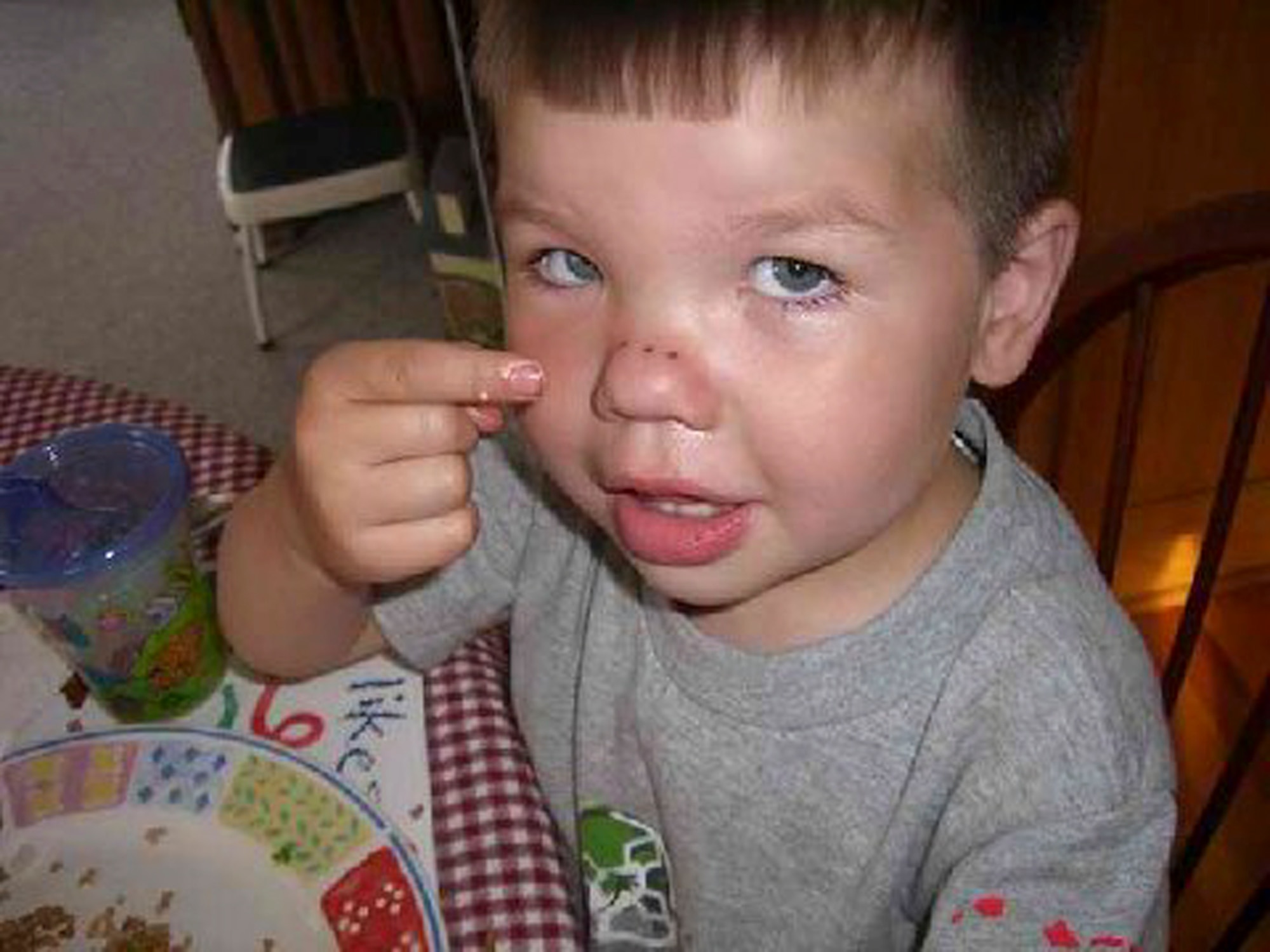 THAT'S GOTTA HURT! - Photos showing boy with fork through nose no hoax: In the emergency room, doctors had to 
remove the fork after three of the tines had pierced the boy?s nose during a fall. Two days later at home, the puncture wounds had already begun to heal. (Courtesy Photo)