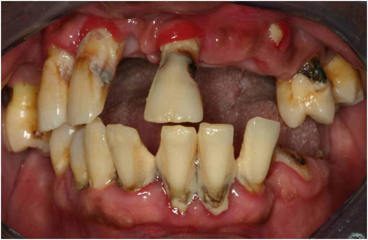 Image result for Oral cancer
