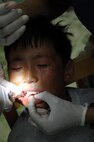 Delgerkhaan, Mongolia – A tooth is prepped for pulling from a young Mongolian boy by U.S. Air Force Staff Sgt. Jose Cardenas, a native of Hildalgo, Texas and currently assigned to the 8th Medical Group, Kunsan Air Base, Republic of Korea and Major (Dr.) Rebecca Neitzke, a native of Grand Rapids Minn., and currently assigned to Kunsan AB, ROK, while at the two-day multinational mobile clinic in Delgerkhaan, Mongolia on July 20 in support of Pacific Angel-Mongolia, a 13th Air Force led combined humanitarian assistance operation. U.S. Soldiers, Sailors and Airmen worked together with Mongolian Armed Forces, Sri Lankan Forces and National Government Organization Project Hope in providing healthcare in Delgerkhaan for two days. Their team moves to a new location every two days to spread out their coverage in the area, while a stationary team works out of a hospital in Ondorkhan, Mongolia.  This is the fourth year of Pacific Angel, but the first time the operation has been hosted in Mongolia. The operation helps cultivate common bonds and foster goodwill between the United States, Mongolia and other regional nations. In addition to veterinary training, a clinic is being refurbished and medical outreach events are being held in Ondorkhan, Delgerkhaan and Tsenkhermandal soums of the Hentii province from July 18-23.  (U.S. Air Force photo/Master Sgt. Cohen A. Young)

