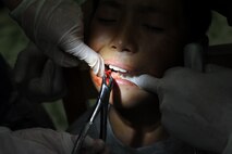 Delgerkhaan, Mongolia – A young Mongolian boy has his tooth pulled by U.S. Air Force Staff Sgt. Jose Cardenas, a native of Hildalgo, Texas and currently assigned to the 8th Medical Group, Kunsan Air Base, Republic of Korea and Major (Dr.) Rebecca Neitzke, a native of Grand Rapids Minn., and currently assigned to Kunsan AB, ROK, while at the two-day multinational mobile clinic in Delgerkhaan, Mongolia on July 20 in support of Pacific Angel-Mongolia, a 13th Air Force led combined humanitarian assistance operation. U.S. Soldiers, Sailors and Airmen worked together with Mongolian Armed Forces, Sri Lankan Forces and National Government Organization Project Hope in providing healthcare in Delgerkhaan for two days. Their team moves to a new location every two days to spread out their coverage in the area, while a stationary team works out of a hospital in Ondorkhan, Mongolia.  This is the fourth year of Pacific Angel, but the first time the operation has been hosted in Mongolia. The operation helps cultivate common bonds and foster goodwill between the United States, Mongolia and other regional nations. In addition to veterinary training, a clinic is being refurbished and medical outreach events are being held in Ondorkhan, Delgerkhaan and Tsenkhermandal soums of the Hentii province from July 18-23.  (U.S. Air Force photo/Master Sgt. Cohen A. Young)
