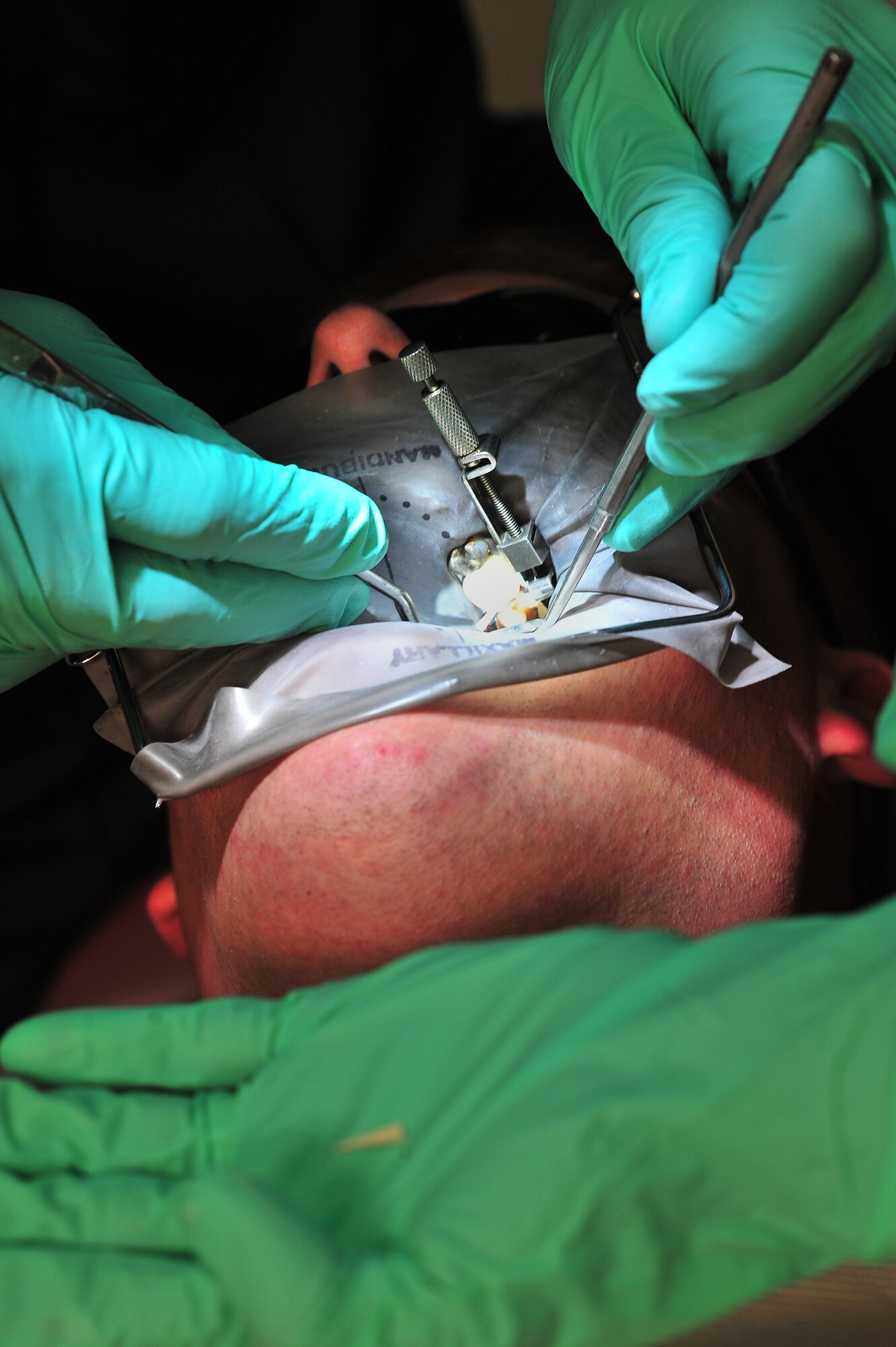 An Airman assigned to the 20th Security Forces Squadron has routine dental work done July 20, 2011, Shaw Air Force Base, S. C. Shaw’s Dental Clinic is vital to mission readiness as all Airmen are required to have any dental issues taken care of prior to deployment. (U.S. Air Force photo by Airman 1st Class Ashley Gardner)(Released)
