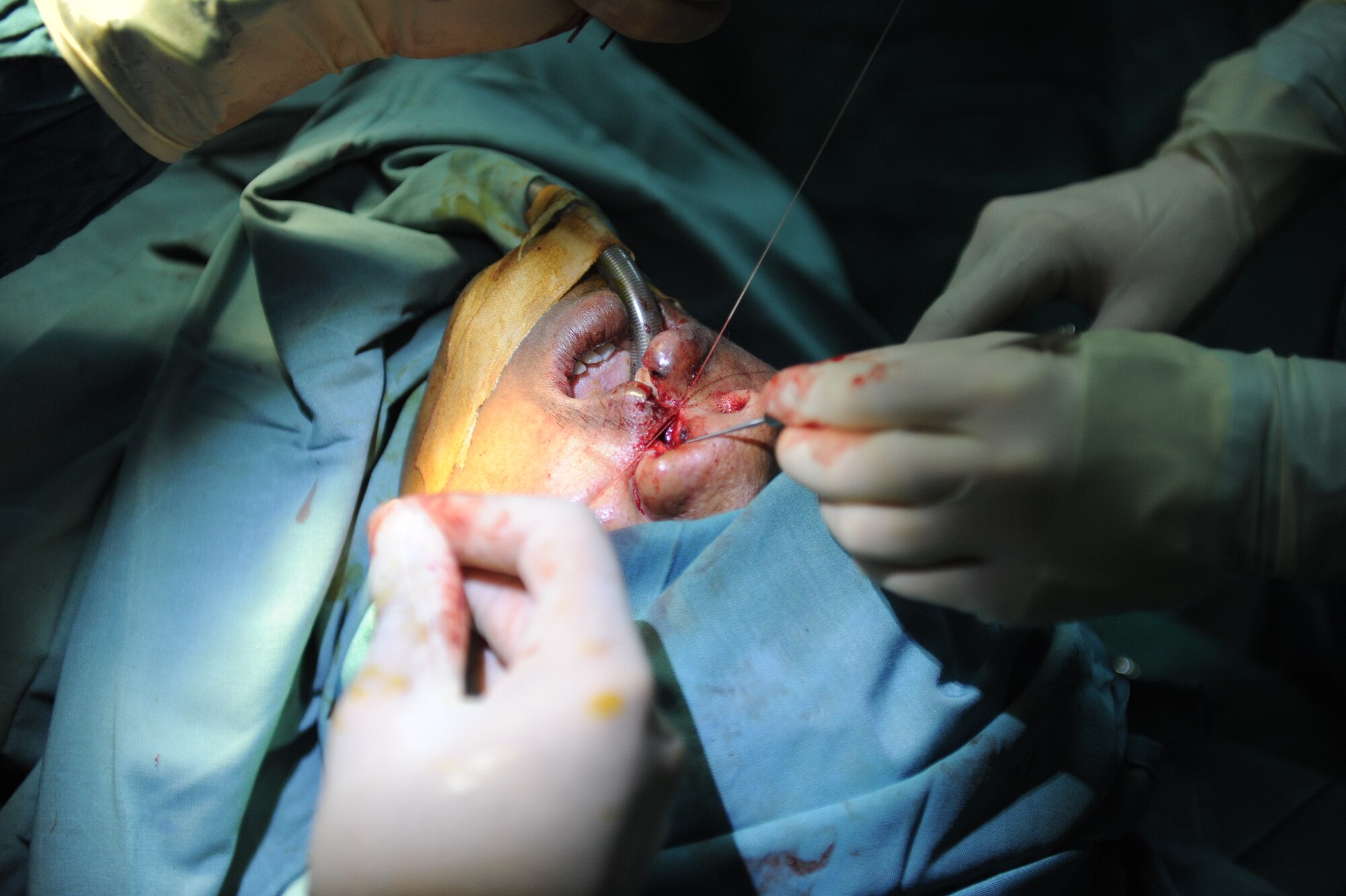 PEKANBARU, Indonesia – A surgeon from the Tripler Army Medical Center, from Honolulu, Hawaii, operates on a 47 year old local Indonesian during operation PACIFIC ANGEL 11-3 here, June 15, 2011. PACANGEL is a series of joint/combined humanitarian civic outreach efforts training conducted in the Pacific. This humanitarian and civic outreach training program is aimed at improving military-civic cooperation between the United States and Indonesia. The operation consists of several civil military assistance programs to include medical civic assistance programs (MEDCAP/DENCAP) with focuses on general health care, dental, optometry, women’s health, and pediatrics. Also included is the engineering civic assistance program (ENCAP), with focus on structural, plumbing, and electric repair of medical clinics and schools. (U.S. Air Force photo/Staff Sgt. Gustavo Gonzalez)