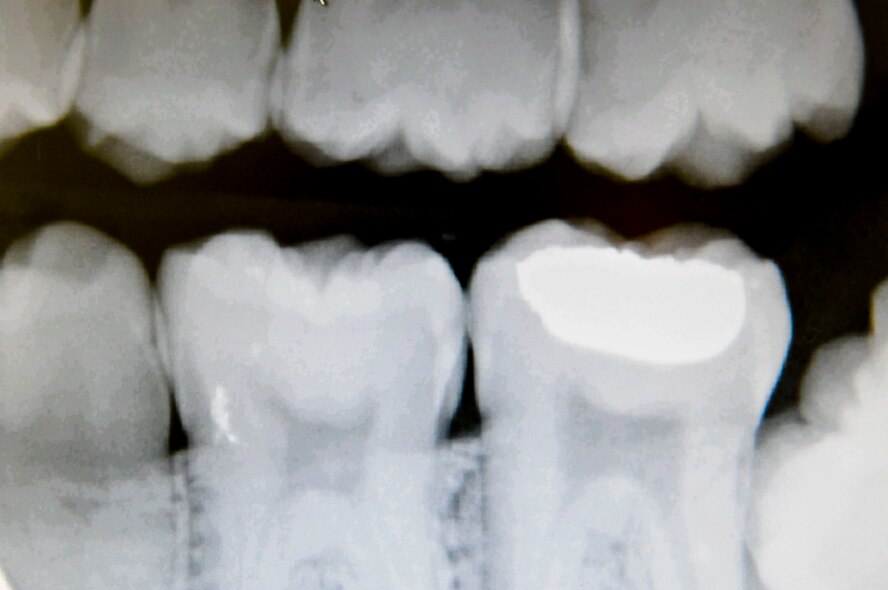 Dental technicians check x-rays before performing routine checkups. X-rays show possible cavities or other dental related issues that dentists can address during a checkup. (U.S. Air Force photo/ Airmen 1st Class Brooke P. Beers)