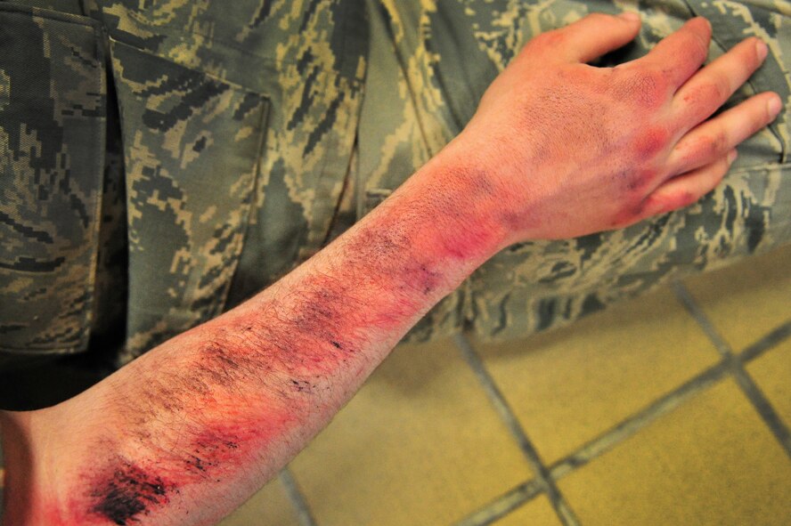 A simulated tornado victim displays a burn wound made with makeup, while waiting for help to arrive during a natural disaster exercise at Cannon Air Force Base, N.M., April 5, 2012. Training exercises provide a safe and controlled environment to practice tactics, techniques and procedures. (U.S. Air Force photo by Tech. Sgt. Josef Cole)