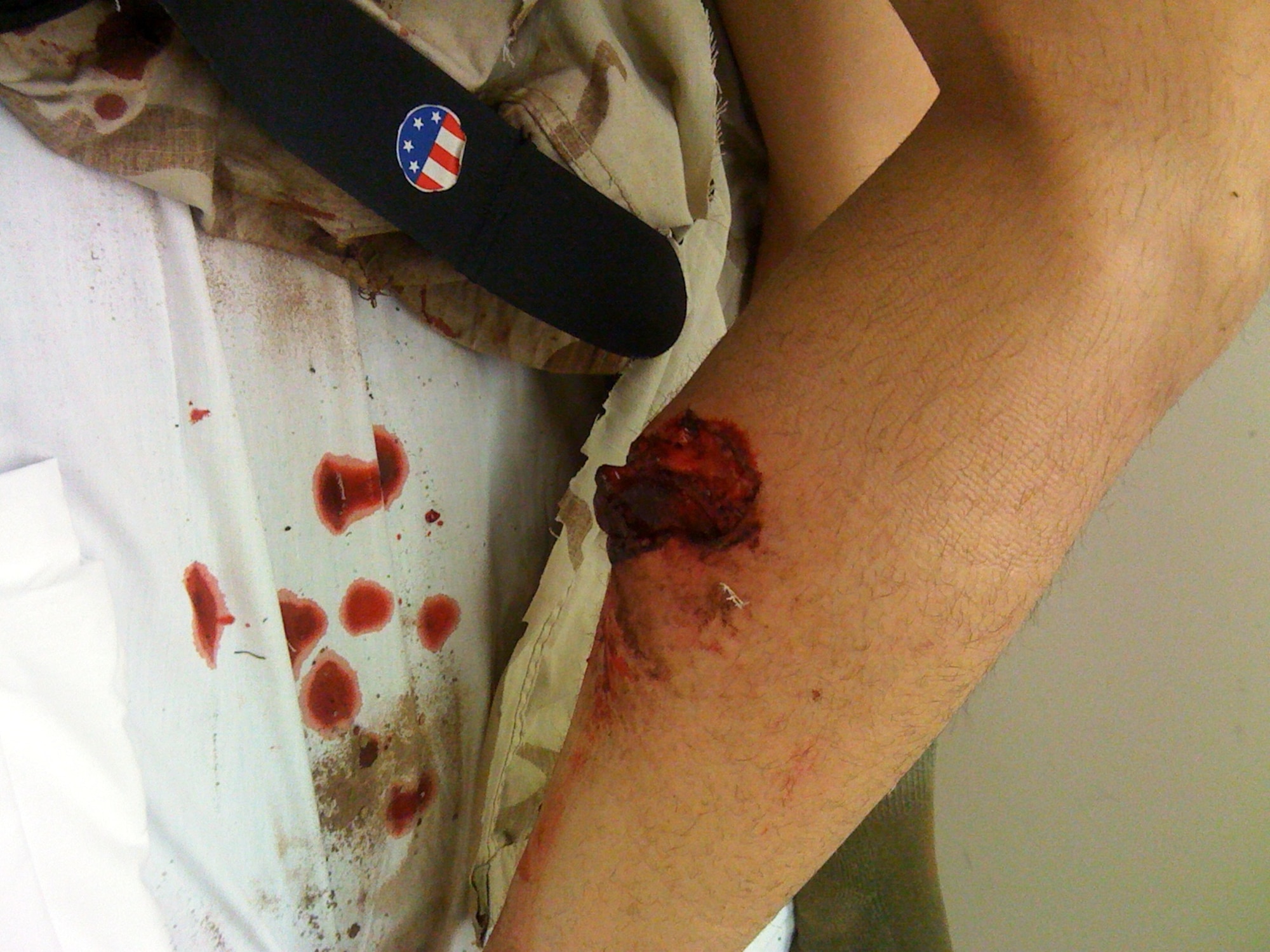 Airman 1st Class James Kirshner, 377th Security Forces Squadron, Kirtland, AFB, N.M., suffered a concussion, shattered collarbone, road rash and a leg laceration when he hit a deep rut while riding his dirt bike. An experienced rider, Kirshner wore proper protective gear and was riding with friends at the time of the accident. His advice to fellow riders is stay within their skill level, pay attention to the surroundings and anticipate what’s around the next turn or at the top of a hill.