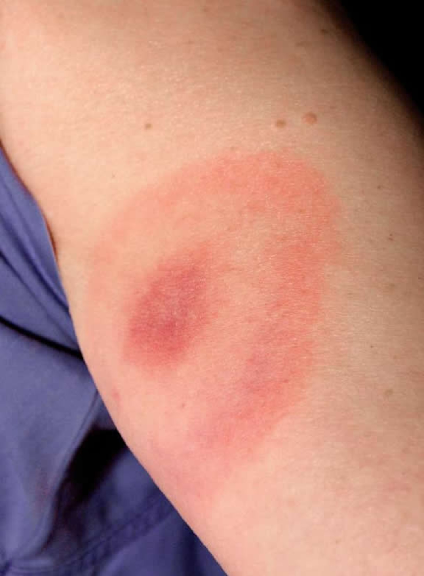 A clear example of a “bull’s-eye” rash can be seen on this victim’s skin. The rash is an indicator of Lyme disease and once it is detected, the victim should seek medical attention. (Photo courtesy of Princeton University)