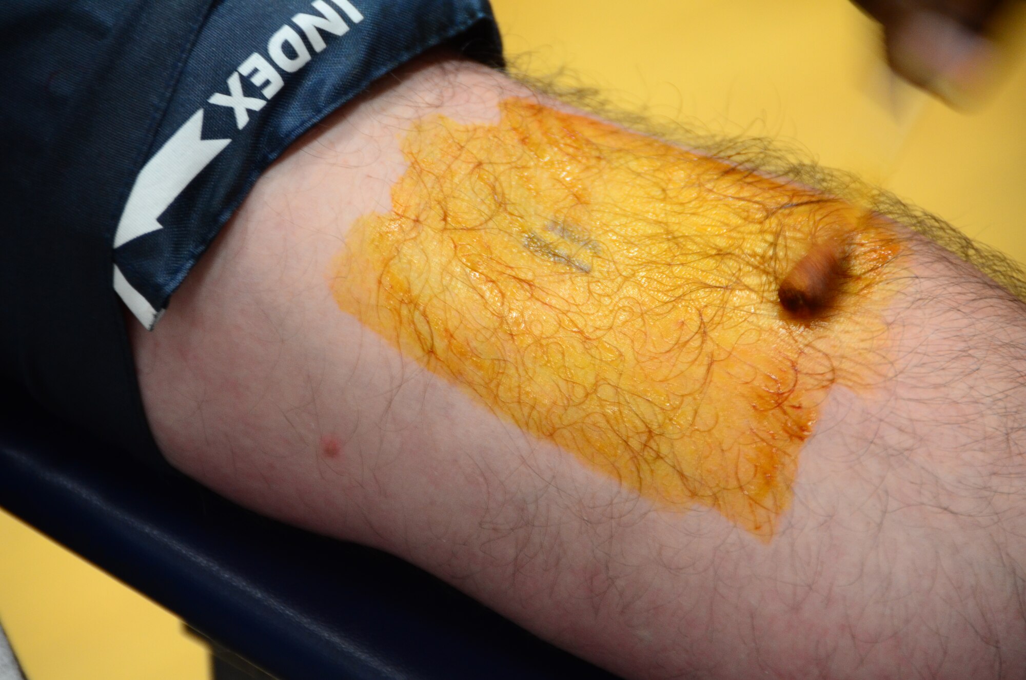 An iodine solution is applied to an arm prior to a blood withdrawal Dec. 12, 2012, in the Joint Base Charleston – Air Base gym. Tech. Sgt. Dustin Smith, 373rd Training Squadron Detachment 5, gave blood as part of Red Cross Blood Drive. The blood drive was open to all base personnel 18 years old and older and 17 with parental consent. (U.S. Air Force photo/William O'Brien)