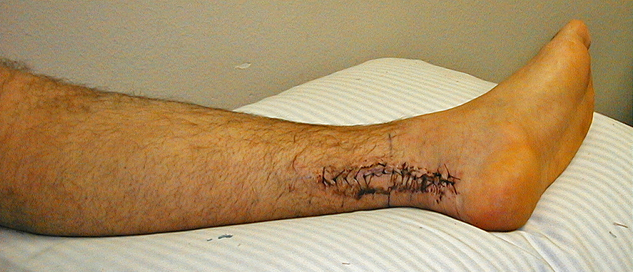 I Ruptured My Achilles Tendon and I Can’t Get Up!