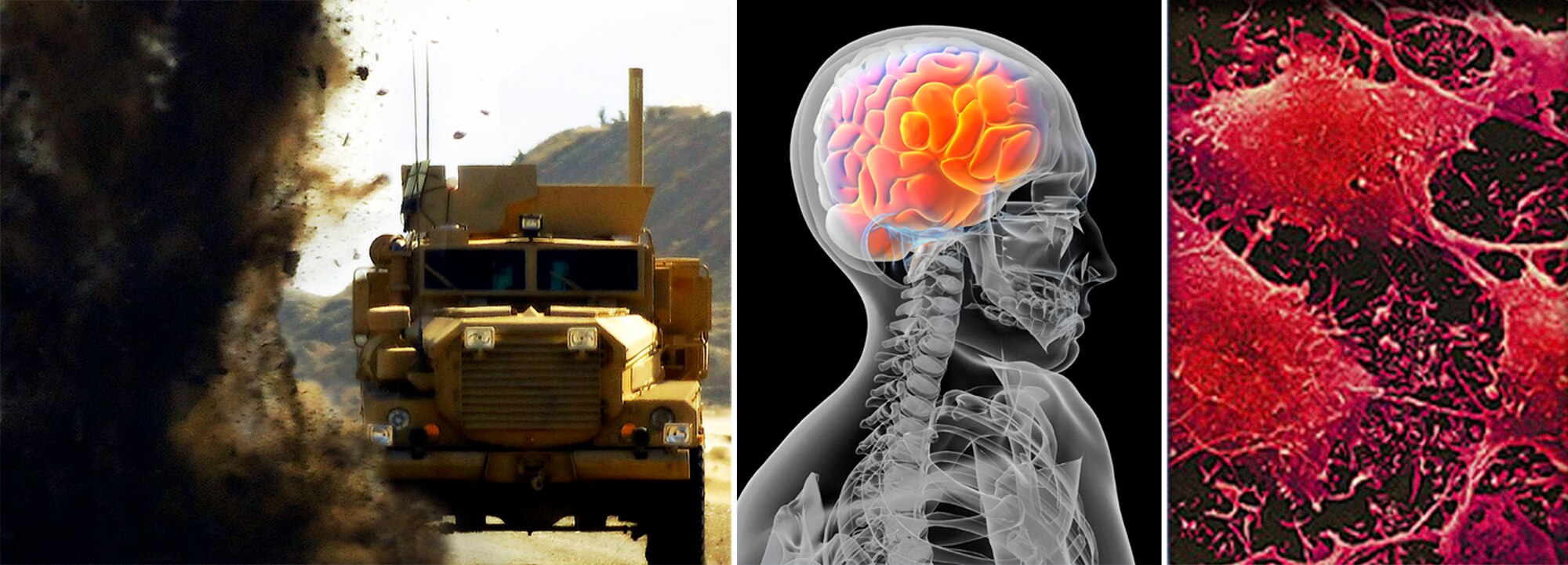 Starting with detonation of an improvised explosive device near an armored vehicle, this illustration demonstrates the dramatic progression of one potential source of traumatic brain injury — from the violent explosion to cellular damage in the brain from the concussion. (Armored vehicle photo by Tech. Sgt. Samuel Bendet/File Graphics)