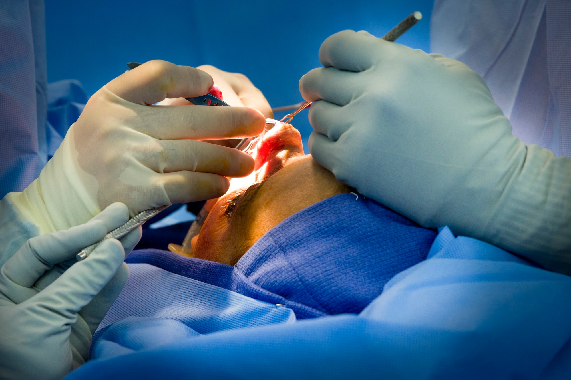YOKOTA AIR BASE, Japan -- Maj. (Dr.) Scott McCusker, 374th Medical Operations Squadron chief of otolaryngology, prepares to place cartilage grafts to reconstitute the nose structure during a rhinoplasty operation at Yokota Air Base, Japan, June 11, 2012. The goal of the surgery is to provide natural-looking result while correcting a breathing issue to help the patient breathe normally. (U.S. Air Force Photo by Staff Sgt. Stacy Moless)
