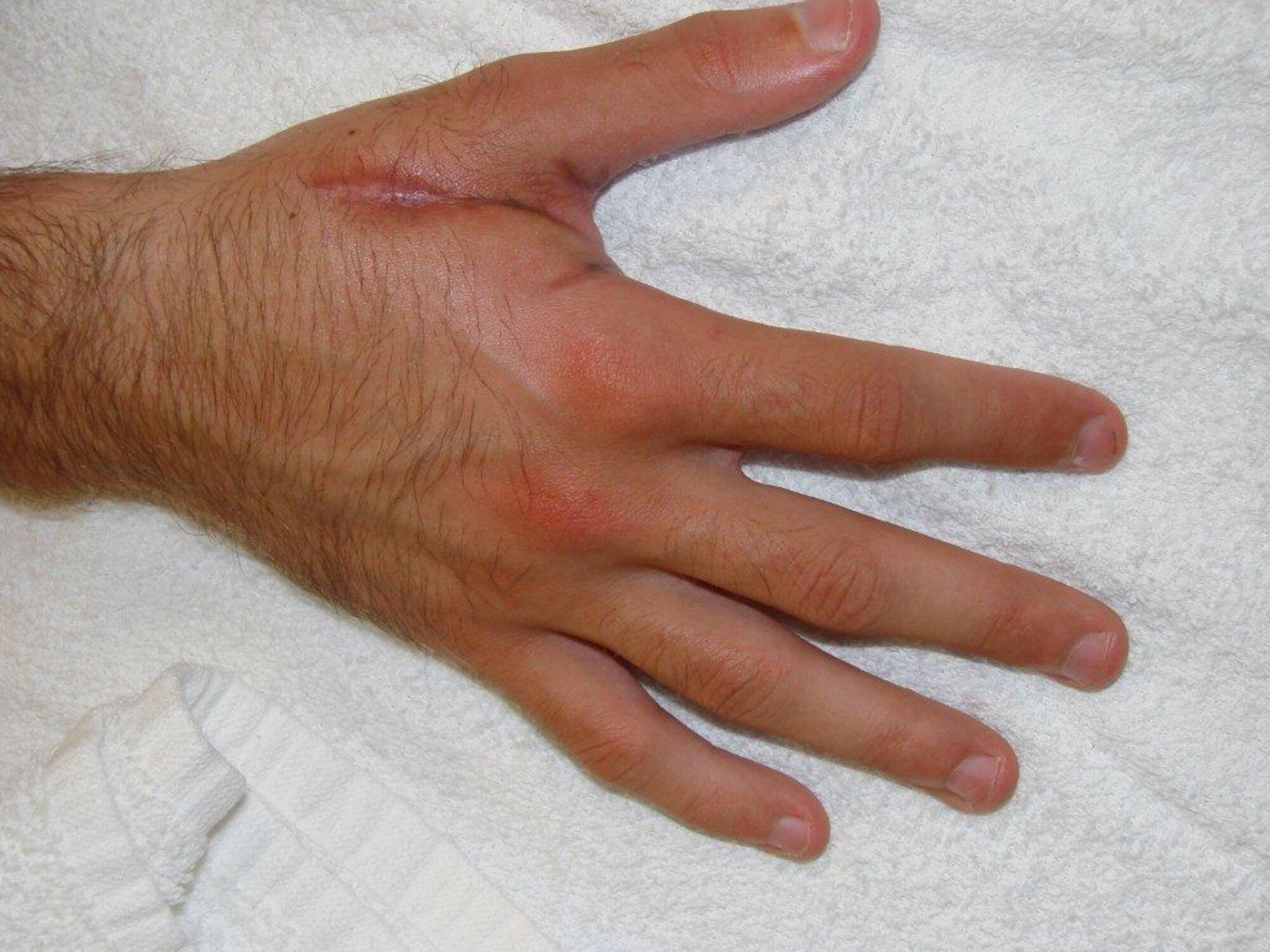 Scars on the hand of Airman 1st Class Sean Huntley serve as a powerful reminder of the importance of firework safety.  The Reservist, now a crew chief assigned to the 931st Aircraft Maintenance Squadron, 931st Air Refueling Group, McConnell Air Force Base, Kan., severely injured his hand in a firework incident five years ago.  Huntley underwent surgery and physical therapy in order to regain full use of the hand.  According to the U.S. Consumer Product Safety Commission, an estimated 8,500 people are treated each year for firework related injuries.  (Courtesy photo)