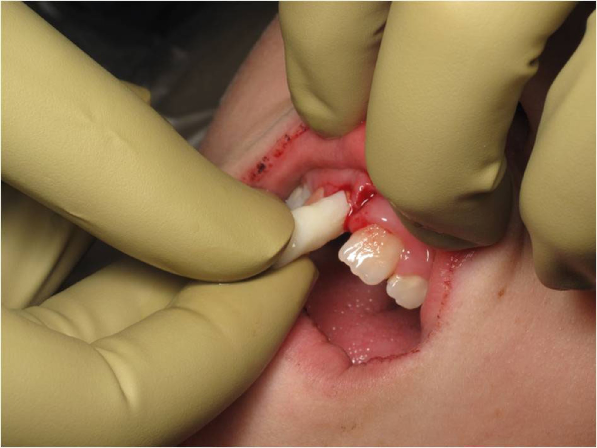 Capt. (Dr.) Mark Stevenson repairs an avulsed tooth on a patient during his residency at Sheppard AFB, Texas, in 2010. The first 30 to 60 minutes after an injury are crucial in determining if a tooth can be repaired or saved, regardless of the type of injury. (Courtesy photo)