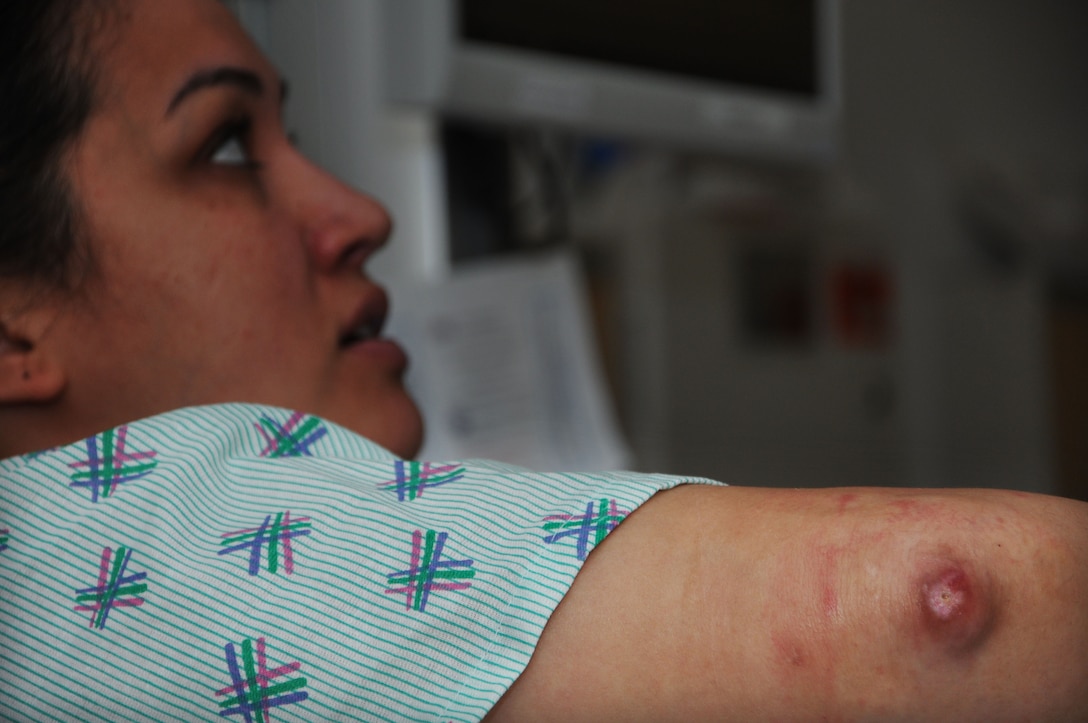 U.S. Air Force Tech. Sgt. Angela Biggs, 633rd Surgical Operations Squadron NCO in charge of women’s health, shows her injured elbow while waiting for surgery at USAF Hospital Langley, May 2, 2012. Biggs' injury was suffered on a deployment to Afghanistan, and aggravated when her forward operating base was attacked. (U.S. Air Force photo by Senior Airman Jarad A. Denton/Released)