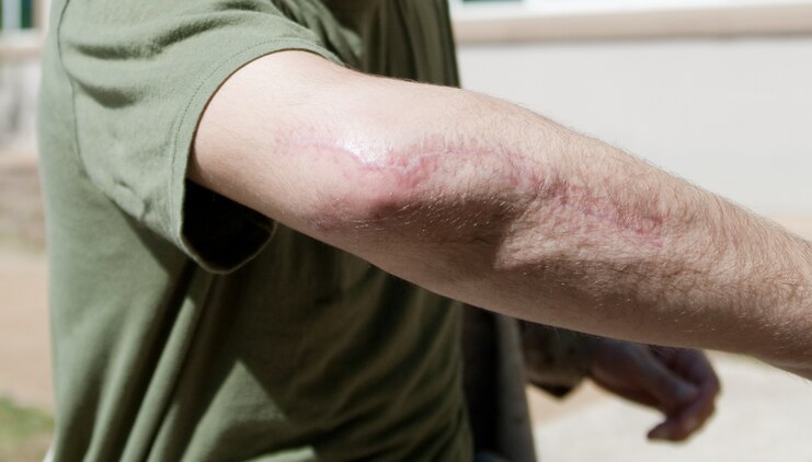 Staff Sgt. Cody Rhode shows the scar from his elbow injury received during his actions Aug. 10 while deployed in Garmsir District, Helmand province, Afghanistan. Rhode, a native of Rogers City, Mich., was shot five times during an attack in Garmsir District, Afghanistan Aug. 10. During this same attack, three Hawaii-based Marines were killed — Staff Sgt. Scott E. Dickinson, Cpl. Richard A. Rivera Jr. and Lance Cpl. Gregory T. Buckley.