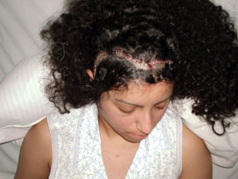 Five days after her first brain surgery to remove a tumor in April 2004, Staff Sgt. Abigail Foster had a scar that measures about 13 inches across. The total recovery time for Foster was five years. She was determined to get back into the Air Force and join Tops in Blue after being medically retired . (Courtesy Photo)