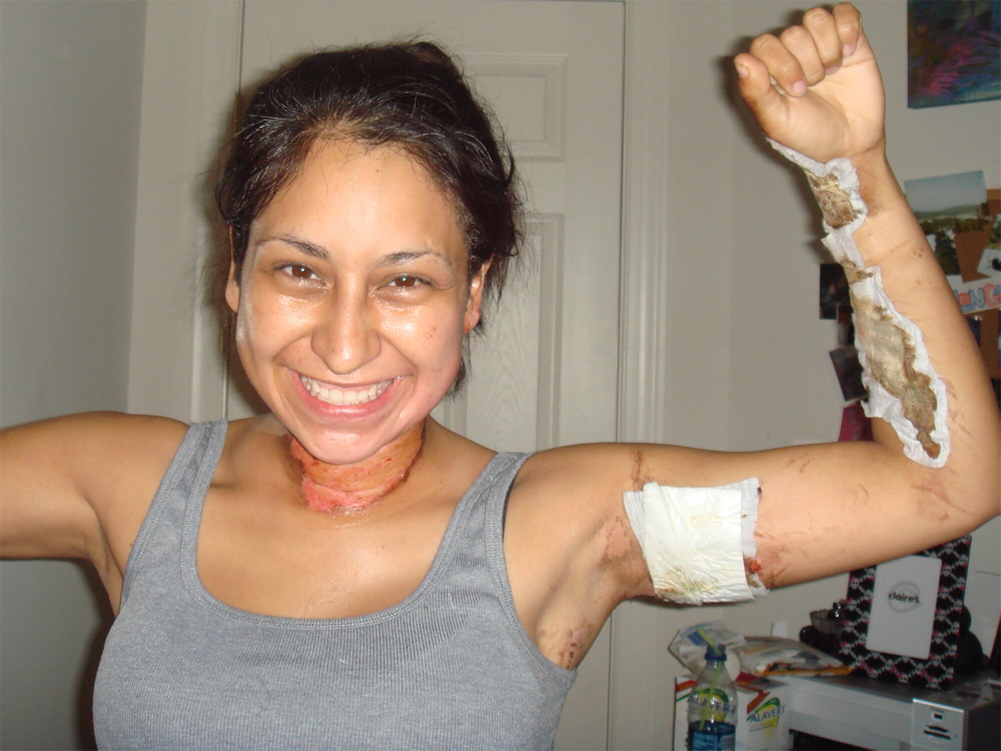 Luke proved to be resilient despite her agonizing burns. She suffered second-degree burns to her torso just above the left armpit, the left and front of her neck, the left side of her face and ear, as well as to her left arm and both hands. (Courtesy photo)