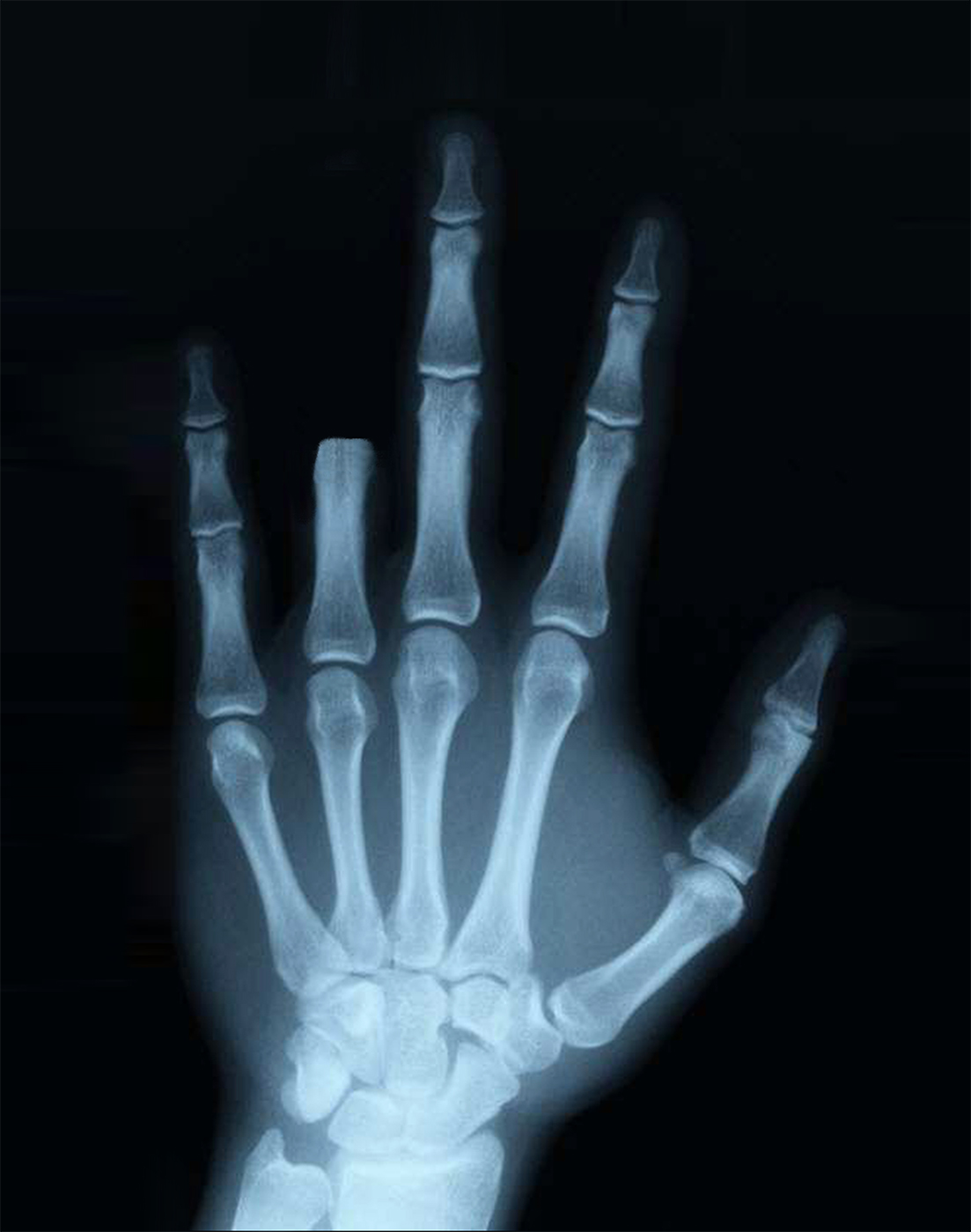 FOURFINGER DISCOUNT? Preventable mishaps 'stealing' digits at record