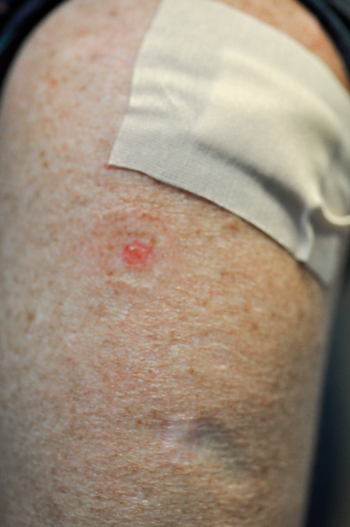 Nancy Carlson, a military spouse, shows some of the scars she has from cancerous lesions on her skin that have since been removed, July 16, 2013 at Fort Eustis, Va. In the last three decades, more people have had skin cancer than all other cancers combined and more than 90 percent of non-melanoma skin cancers are associated with ultraviolet radiation from the sun. (U.S. Air Force photo by Tech. Sgt. April Wickes/Released)  