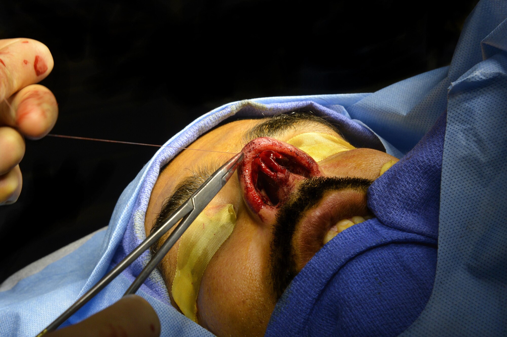 Major Jamie Swartz, an ear nose and throat surgeon, sutures a patients nose after performing an open septorhinoplasty in the Craig Joint Theater Hospital on Bagram Airfield, Afghanistan, July 22, 2013. The procedure performed separated his nose into a left and right side, straightening the septum and bones, reducing the obstruction and allowing the patient to breathe better. The patient had problems breathing, headaches and pressure because of an obstruction inside his nose. Swartz is assigned to the 455th Expeditionary Medical Group and deployed from Langley Air Force Base, Va.  (U.S. Air Force photo/Staff Sgt. Stephenie Wade)