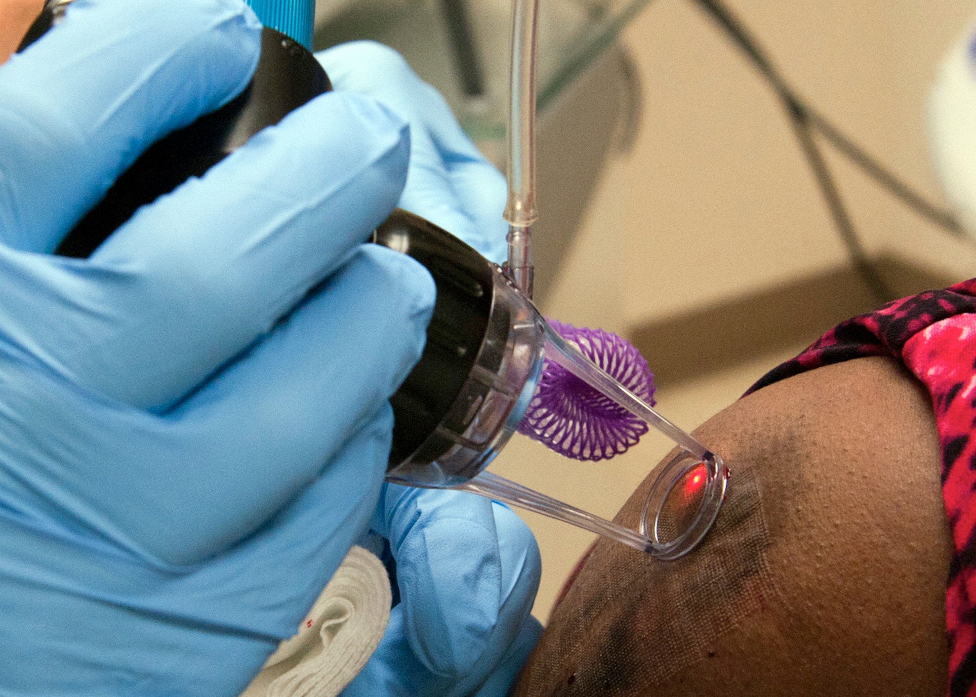 Lt. Col. Chad Hivnor uses a carbon dioxide fractional laser to help improve skin texture and flexibility on a wounded warrior's scarred shoulder in the Dermatology Clinic at Wilford Hall Ambulatory Surgical Center, Joint Base San Antonio-Lackland, Texas Aug. 7. Hivnor was awarded a 1.1 million dollar grant to study using lasers for improvement in range of motion on burn and amputee scars in a joint research project with Massachusetts General Hospital and Shriner’s Hospital of Boston. (U.S. Air Force photo/Senior Airman Courtney Moses)