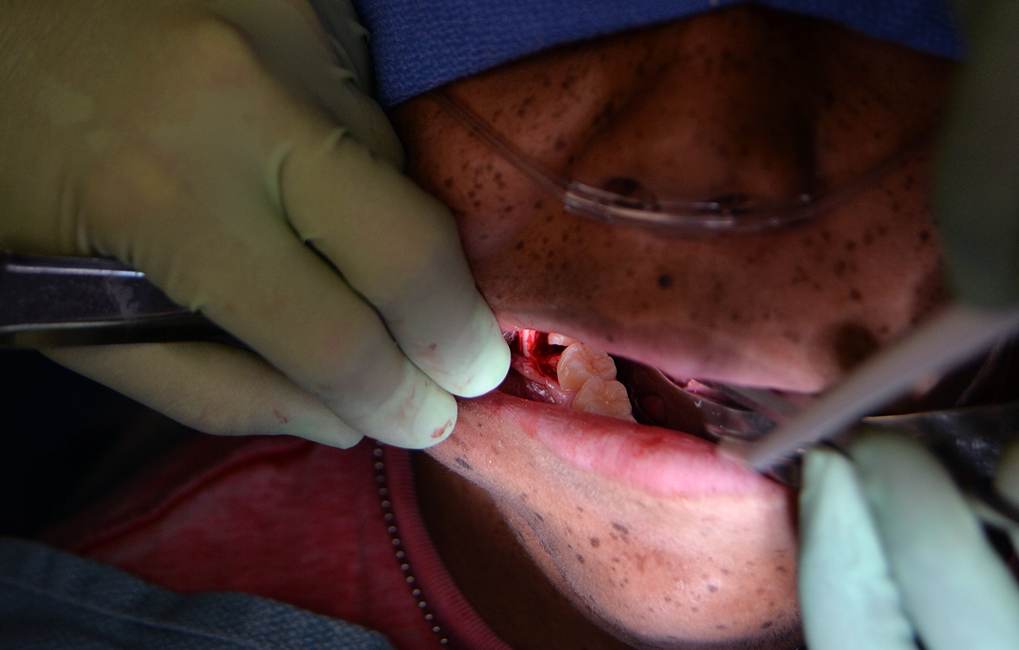 A patient has his wisdom teeth removed at the dental clinic on Hurlburt Field, Fla., Nov. 19, 2013. Capt. Jeff Larkin, 1st Special Operations Dental Squadron general clinical dentist, removed all four wisdom teeth from a patient during a routine extraction. (U.S. Air Force photo/Staff Sgt. Jeff Andrejcik)  