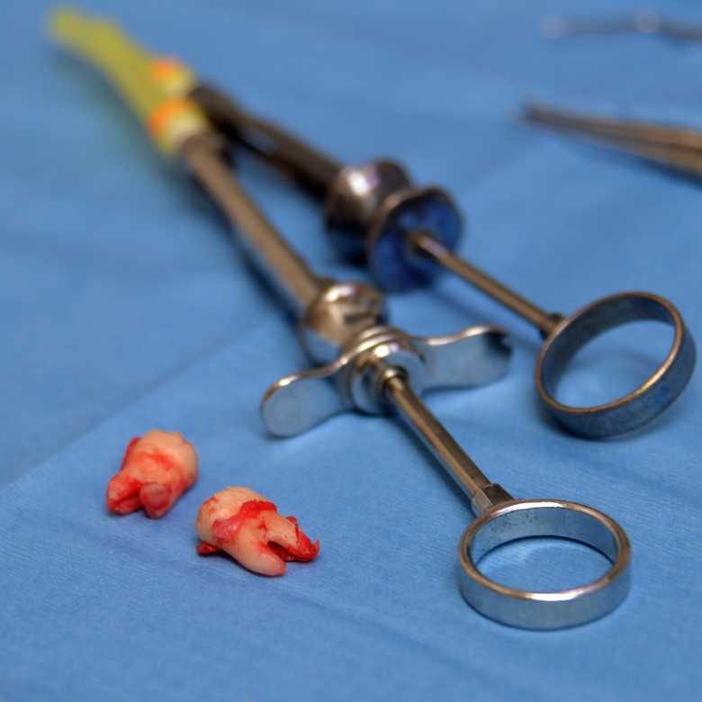 How To Clean Wisdom Teeth With Syringe at Dana Marshall blog