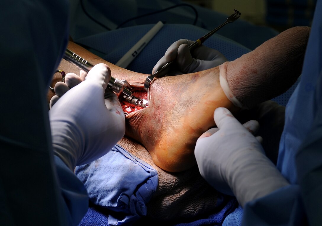 U.S. Air Force Maj. Michael Tompkins, M.D., 633rd Surgical Operations Squadron orthopedic surgeon, uses screws to ensure proper placement of a metal plate in a patient’s ankle during a procedure at Langley Air Force Base, Va., Feb. 5, 2013. Orthopedic surgerons use both surgical and nonsurgical means to treat musculoskeletal trauma, sports-related injuries, degenerative diseaes, infections, tumors and congenital disorders. (U.S. Air Force photo by Senior Airman Teresa Aber/Released)