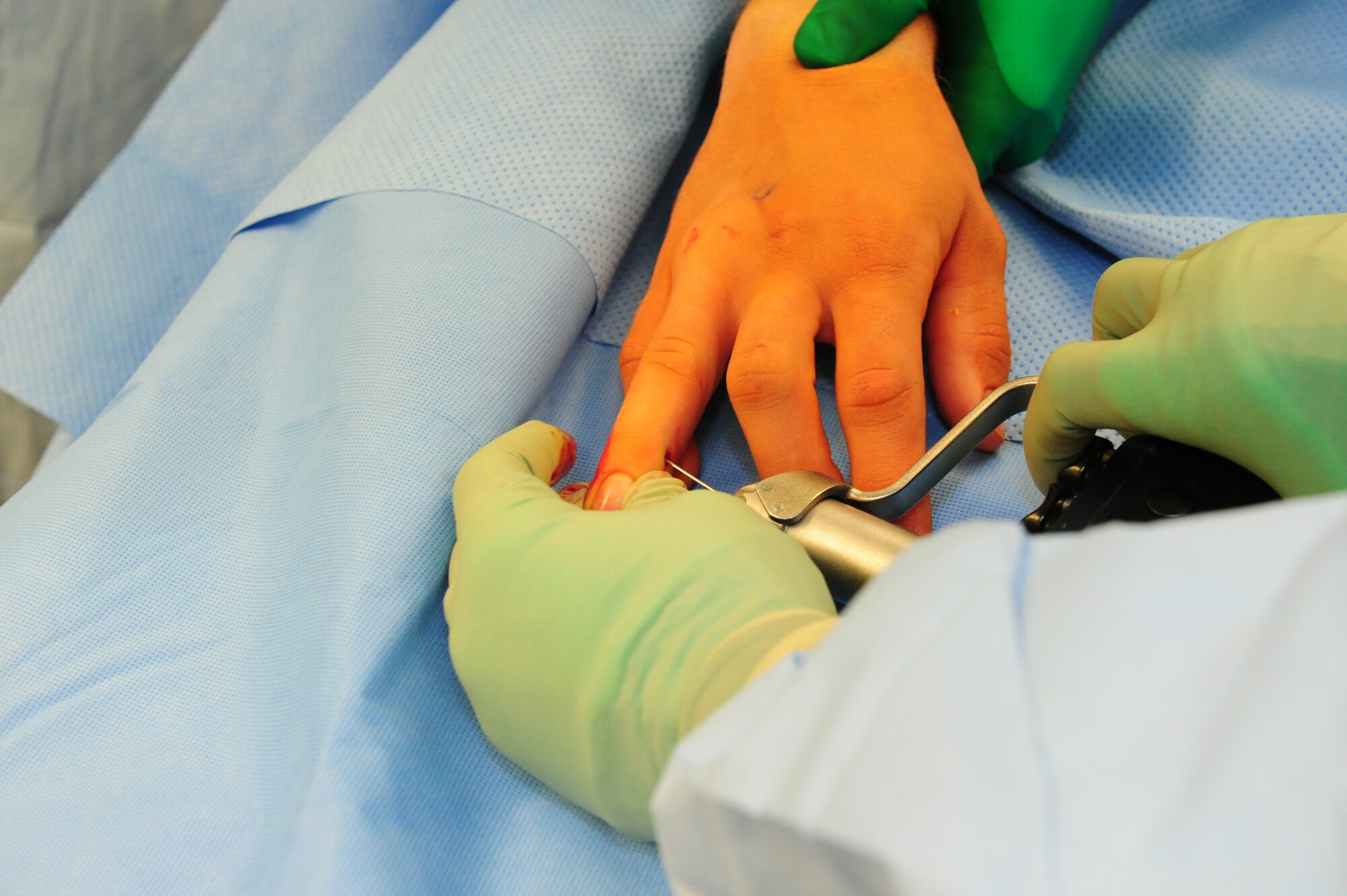 SOUTHWEST ASIA – Maj. James Walsh, 379th Expeditionary Medical Group surgeon, sets pins in the patient’s hand to keep the fractured bones together Feb. 7. Walsh is deployed from Joint Base Langley-Eustis, Va. (U.S. Air Force photo/Master Sgt. Brendan Kavanaugh)