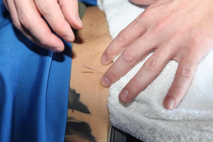 Acupuncture is an alternative to traditional Western medicine and the side effects they may carry. The procedure involves the insertion of small needles into the skin at designated points. 
