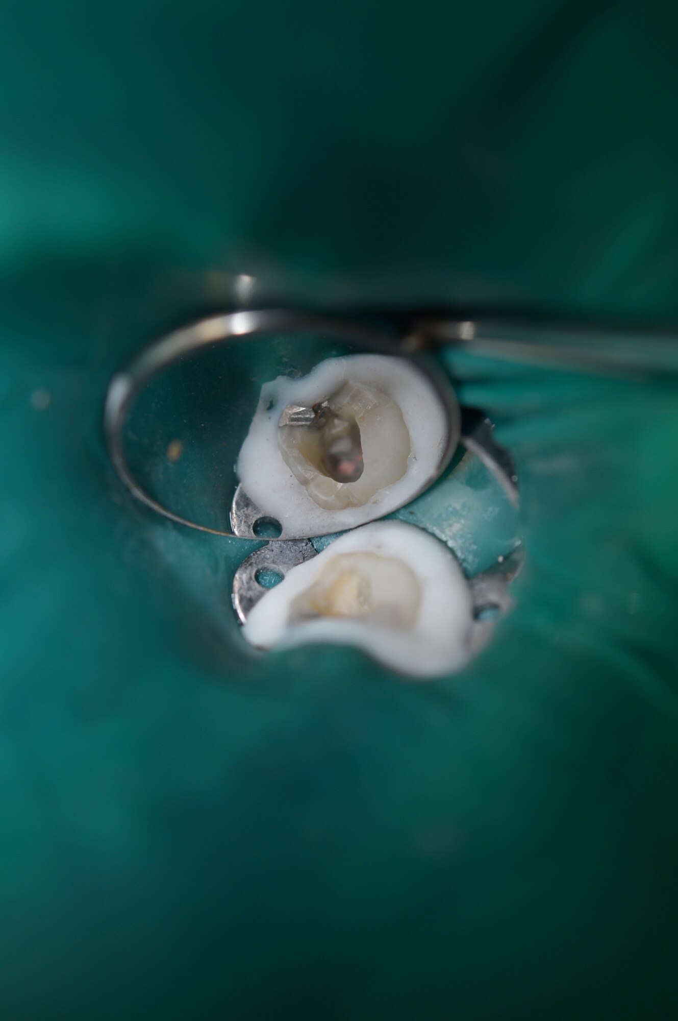 ROYAL AIR FORCE LAKENHEATH, England - An access has been made in the tooth to gain entry to the root canal space Feb. 27, 2013. Root canal treatment addresses diseases of the pulpal tissue inside the tooth and roots. (U.S. Air Force photo by Senior Airman Lausanne Morgan)
