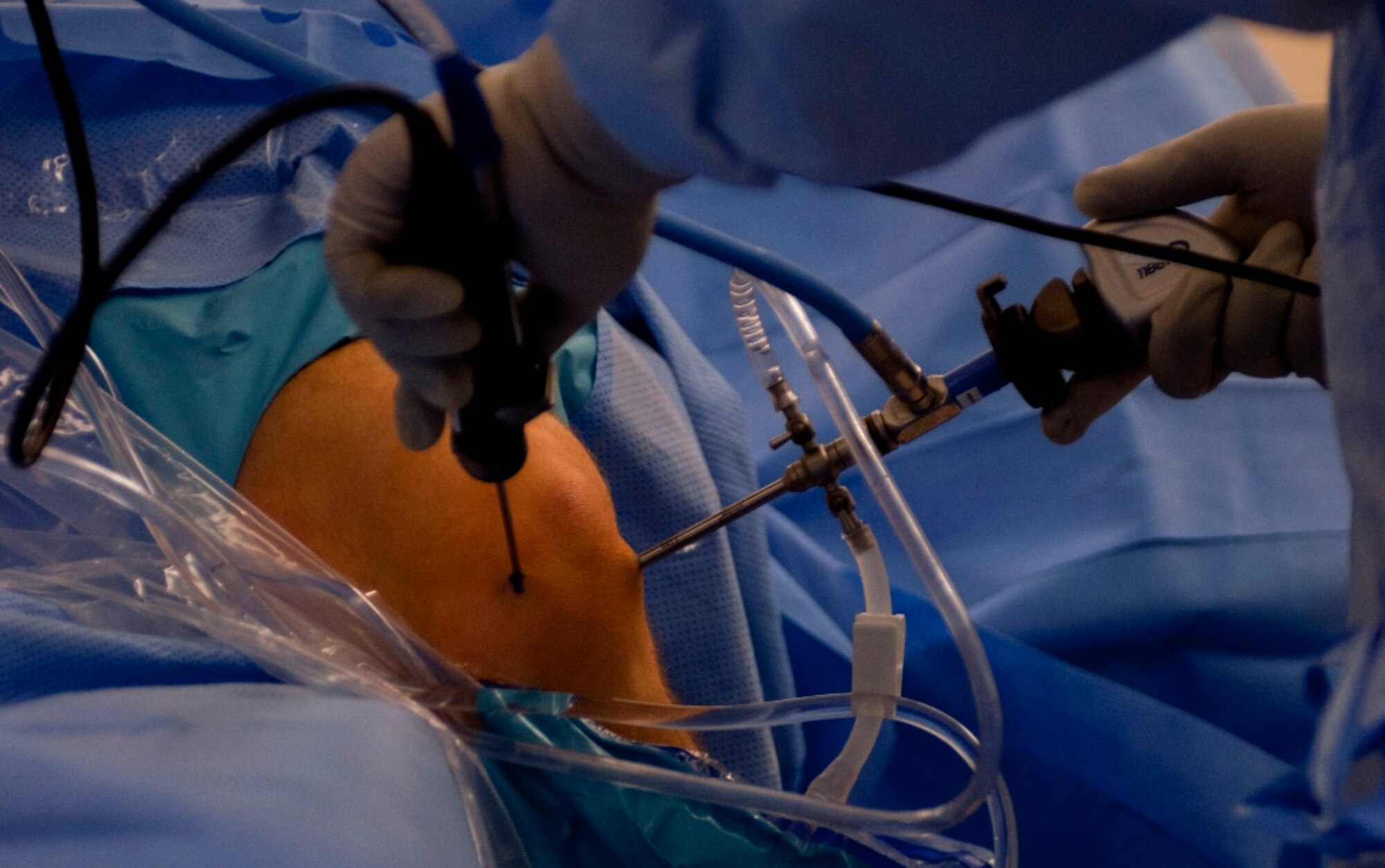 U.S. Army Dr. (Maj.) Rasel Rana, McDonald Army Health Center chief of orthopedic surgery, performs a knee surgery in the MCAHC operating room at Fort Eustis, Va., March 13, 2013. Orthopedics is the branch of medicine focused on conditions involving the musculoskeletal system. Orthopedic surgeons use both surgical and nonsurgical means to treat musculoskeletal trauma, sports-related injuries, degenerative diseases, infections, tumors and congenital disorders. (U.S. Air Force photo by Airman 1st Class R. Alex Durbin/Released)
