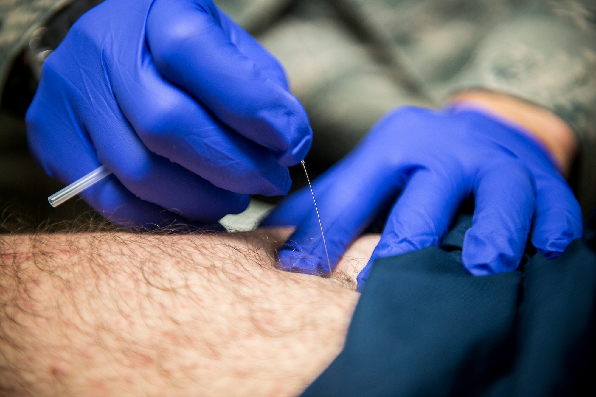 U.S. Air Force Maj. Jon Wilson, 93d Air Ground Operations Wing director of human performance, performs trigger-point dry needling to the right thigh of Tech. Sgt. Jasen Brouillette, 820th Combat Operations Squadron assistant innovative combat equipment NCO, Jan. 9, 2013, at Moody Air Force Base, Ga. Brouillette suffered from a meniscus tear in his knee and has received therapy from Wilson since December 2012. (U.S. Air Force photo by Staff Sgt. Jamal D. Sutter/Released) 