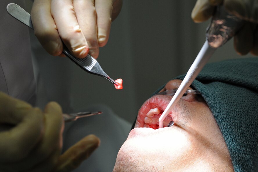 Capt. Peter Pedalino, 35th Dental Squadron periodontist, removes tissue from a patient’s mouth during surgery at Misawa Air Base, Japan, Sep. 4, 2013. As a periodontist, Pedalino focuses on the supporting structures of the teeth, conditions and diseases that affect them. (U.S. Air Force photo by Senior Airman Derek VanHorn)