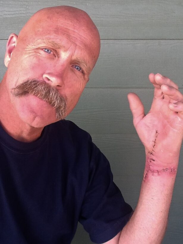Steve Hovis, a paraglider, shows his scars in Billings, M.T., Sept. 10, 2013. Hovis underwent two surgeries to correct the compound fracture in his left arm after crash landing into a ravine while paragliding. (Courtesy photo by Steve Hovis)