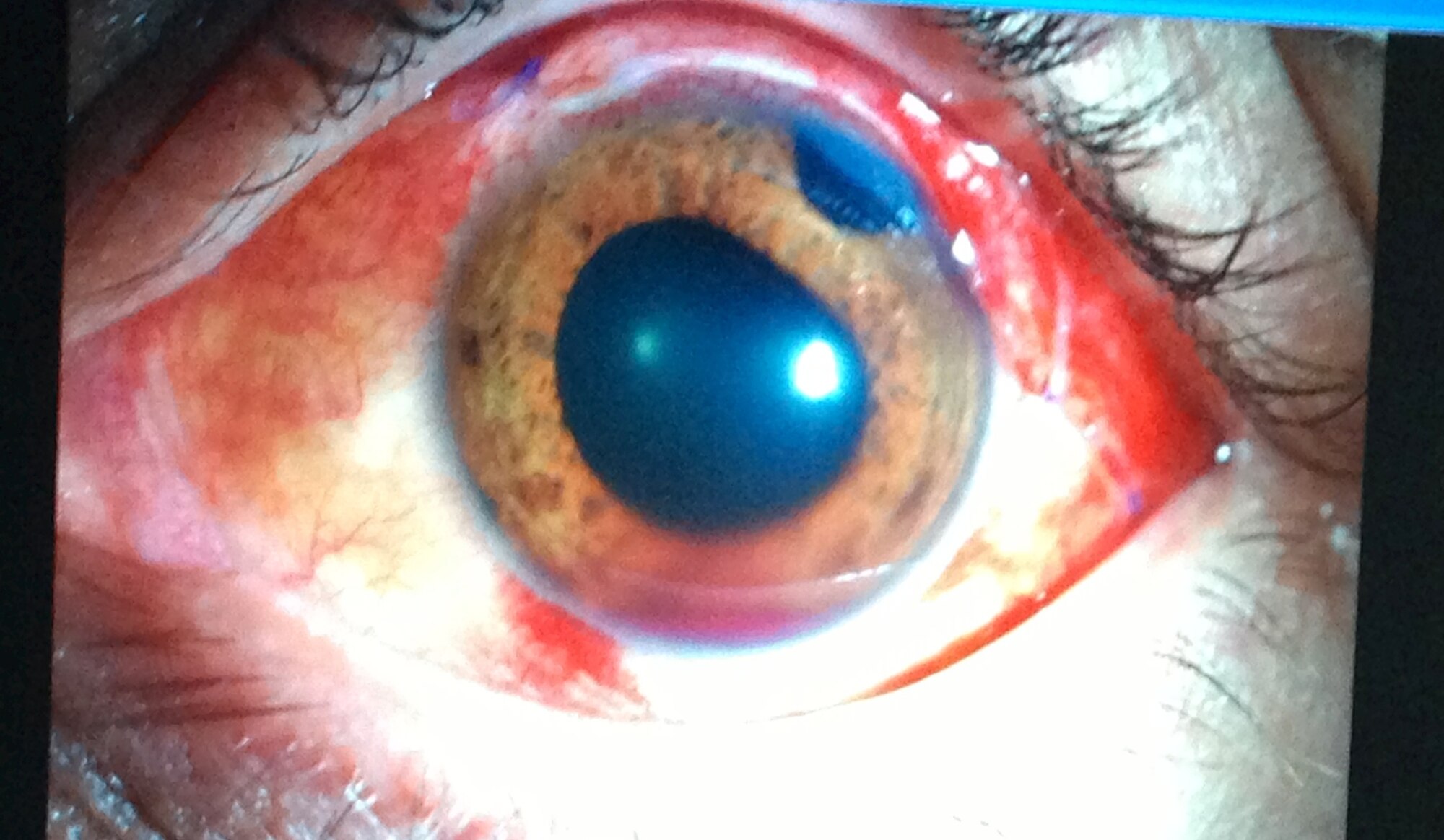 This picture shows Technical Sgt. Chris Hart, 647th Force Support Squadron unit training manager's eye after his surgery to remove cancerous melanoma. Hart received treatment at the University of California, San Francisco on Aug. 8 and is currently recovering in the local area. (Courtesy photo)
