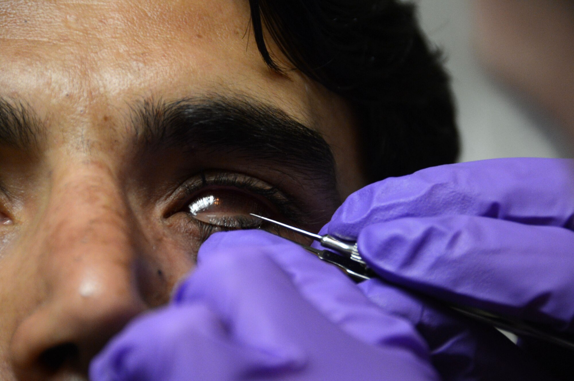 U.S. Air Force Staff Sergeant Vernon Price, a medical technician assigned to the 455th Expeditionary Medical Group, removes a protective glass from the left eye socket of an Afghan soldier prior to placing the prosthetic into his empty eye socket while at the Craig Joint Theater Hospital at Bagram Airfield, Afghanistan Aug. 7, 2014. The soldier suffered an eye trauma when shrapnel from an explosion hit him four months ago. Price is a native of Goldsborough, N.C. and deployed form the 4th Aerospace Medicine Squadron at Seymour Johnson Air Force Base, N.C. (U.S. Air Force photo by Master Sgt. Cohen A. Young/Released)