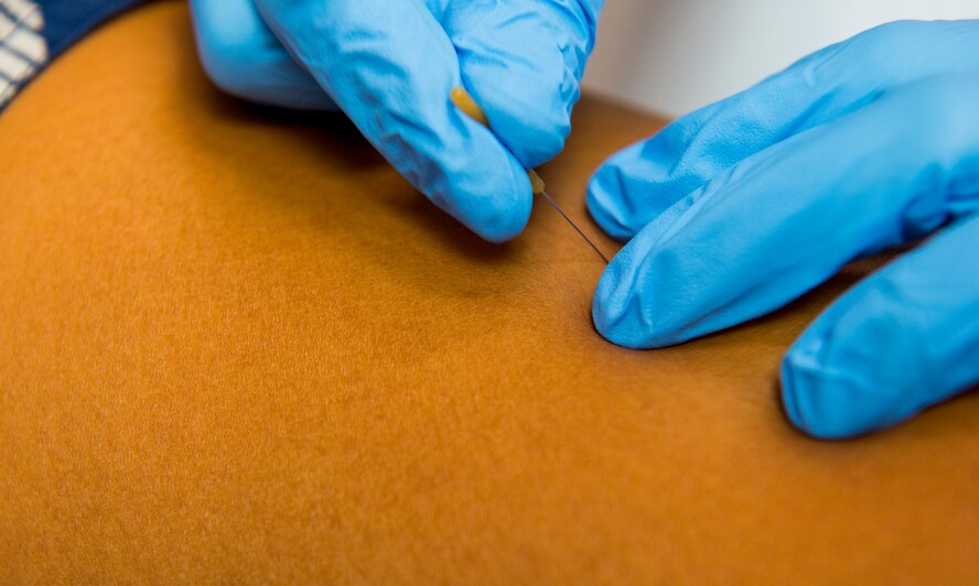 U.S. Air Force Maj. (Dr.) Erin Sturgell, 23d Medical Operations Squadron clinical medicine flight commander, inserts a needle to perform a dry needling technique during a demonstration in the 23d MDOS physical therapy clinic at Moody Air Force Base, Ga., Aug. 19, 2014. Dry needling is a trigger point release therapy used by the physical therapy clinic to relieve pain. (U.S. Air Force photo by Airman 1st Class Ceaira Tinsley/Released)