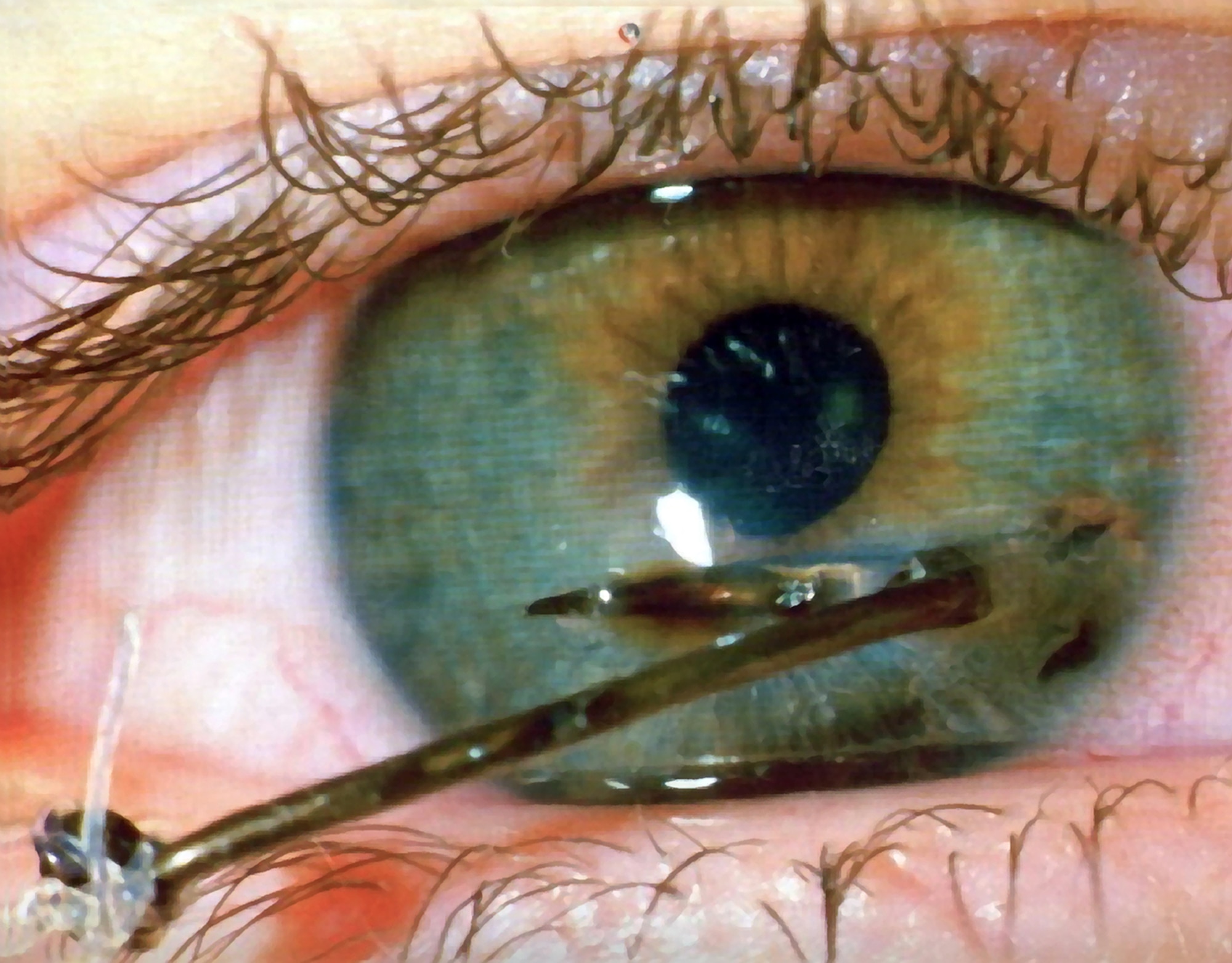 Many fishing hooks have barbs that make them difficult to remove if they embed in an eye. If you or a buddy do catch a hook in the eye, do not try to remove it yourself, as you may cause more damage. Tape the lure to your brow to keep its weight from tugging on your eyeball and get to the nearest hospital immediately. (Courtesy photo)