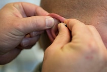 Capt. Laramie Richmond, 5th Medical Operations Squadron personnel reliability program clinic physician’s assistant, places studs in a patient’s ear at Minot Air Force Base, N.D., May 22, 2014. Several studs are placed in specific parts of both ears to relieve pain throughout different areas of the body. (U.S. Air Force photo/Airman 1st Class Sahara L. Fales)