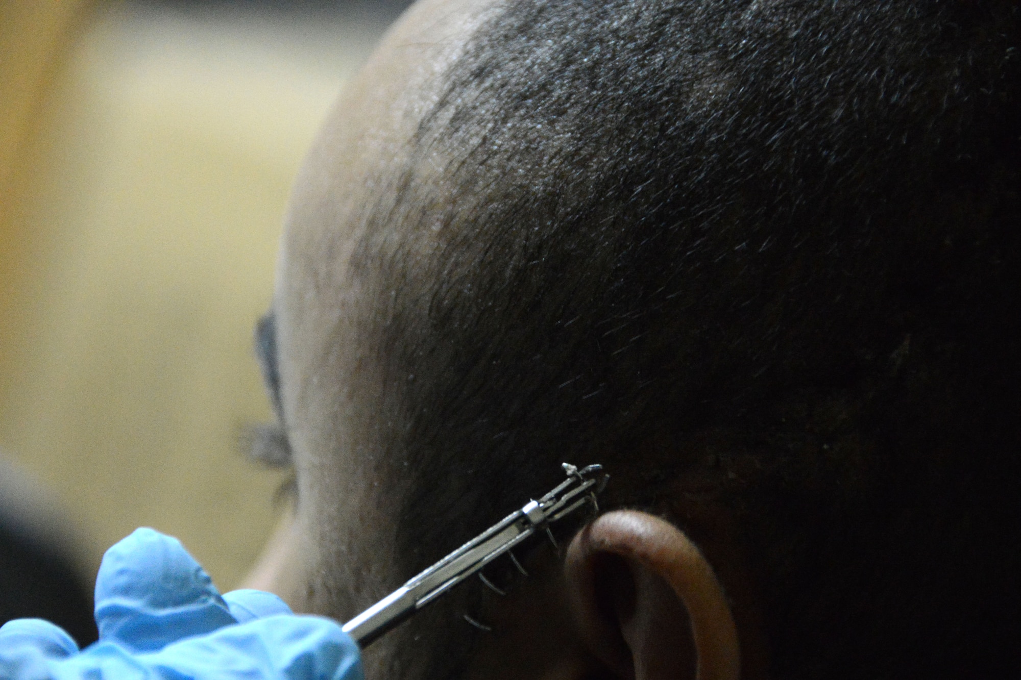 U.S. Air Force Maj. Jonathan Forbes, a neurosurgeon assigned to the 455th Expeditionary Medical Group, removes a staple from a patient’s head Oct. 22, 2014 at Bagram Airfield, Afghanistan. Forbes, deployed from Travis Air Force Base, Calif., removed a tumor from the man’s brain 12 days earlier. (U.S. Air Force photo by Master Sgt. Cohen A. Young/Released)