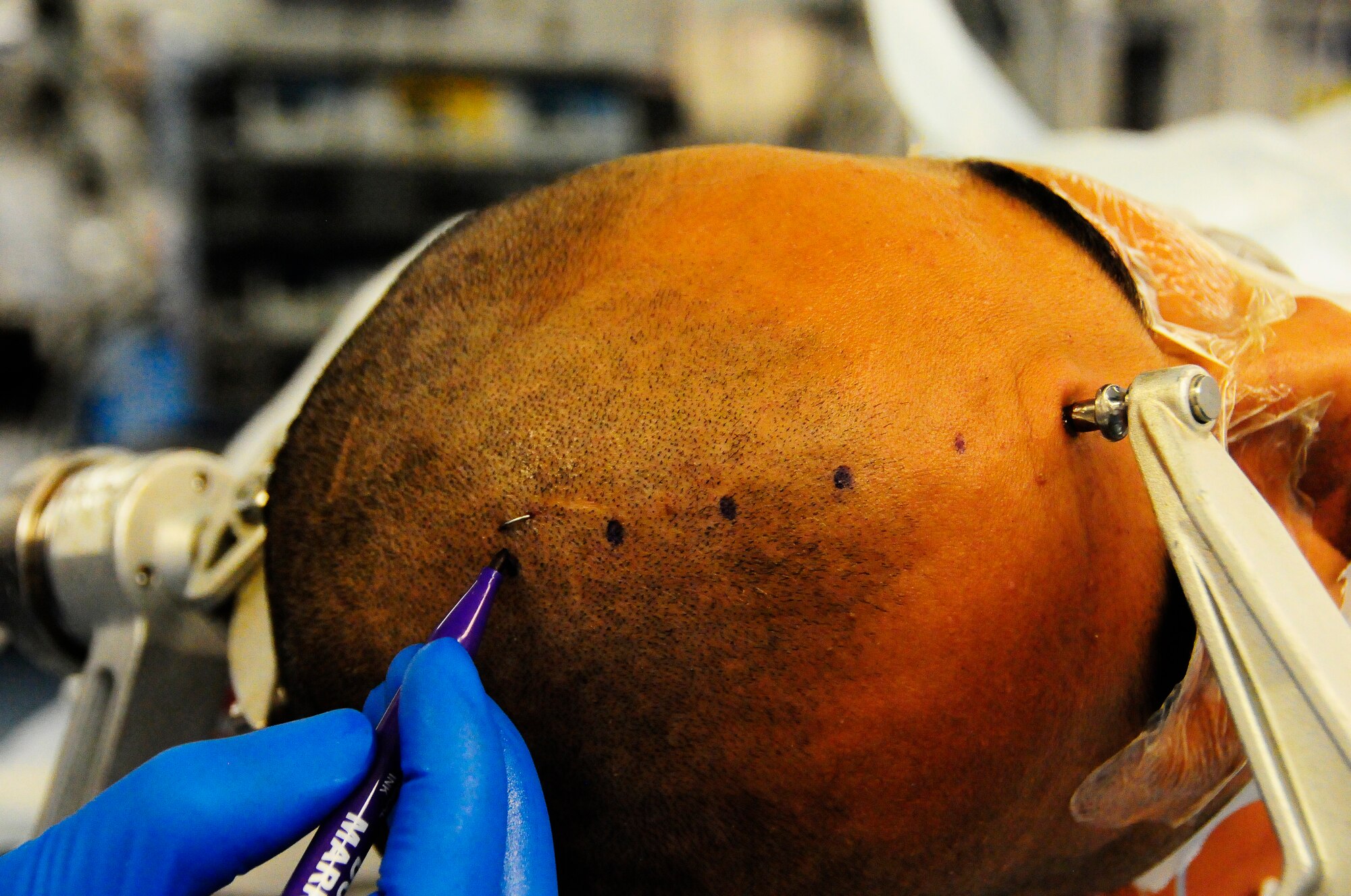 U.S. Air Force Maj Jonathan Forbes, 455th Expeditionary Medical Operations Squadron neurosurgeon marks a patients’ head prior to performing brain surgery at the Craig Joint Theater Hospital, Bagram Airfield, Afghanistan Oct 10, 2014.  Forbes removed an 8 centimeter tumor from the patient’s head.  Forbes is deployed from Travis Air Force Base, Calif and a native of New Martinsville, W.V.  (U.S. Air Force photo by Staff Sgt. Miguel Lara III/Released)