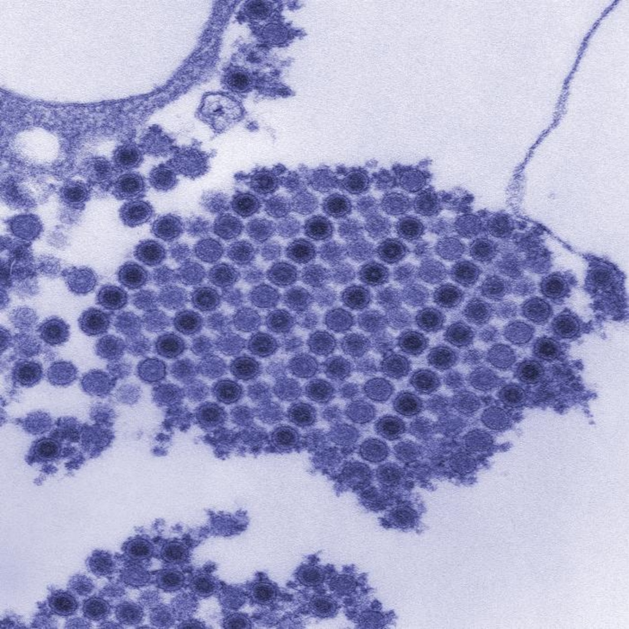 This digitally colorized transmission electron micrograph shows numerous Chikungunya virus particles that are composed of a central dense core surrounded by a viral envelope. Each virion is about 50 nanometers in diameter. CDC photo by Cynthia Goldsmith