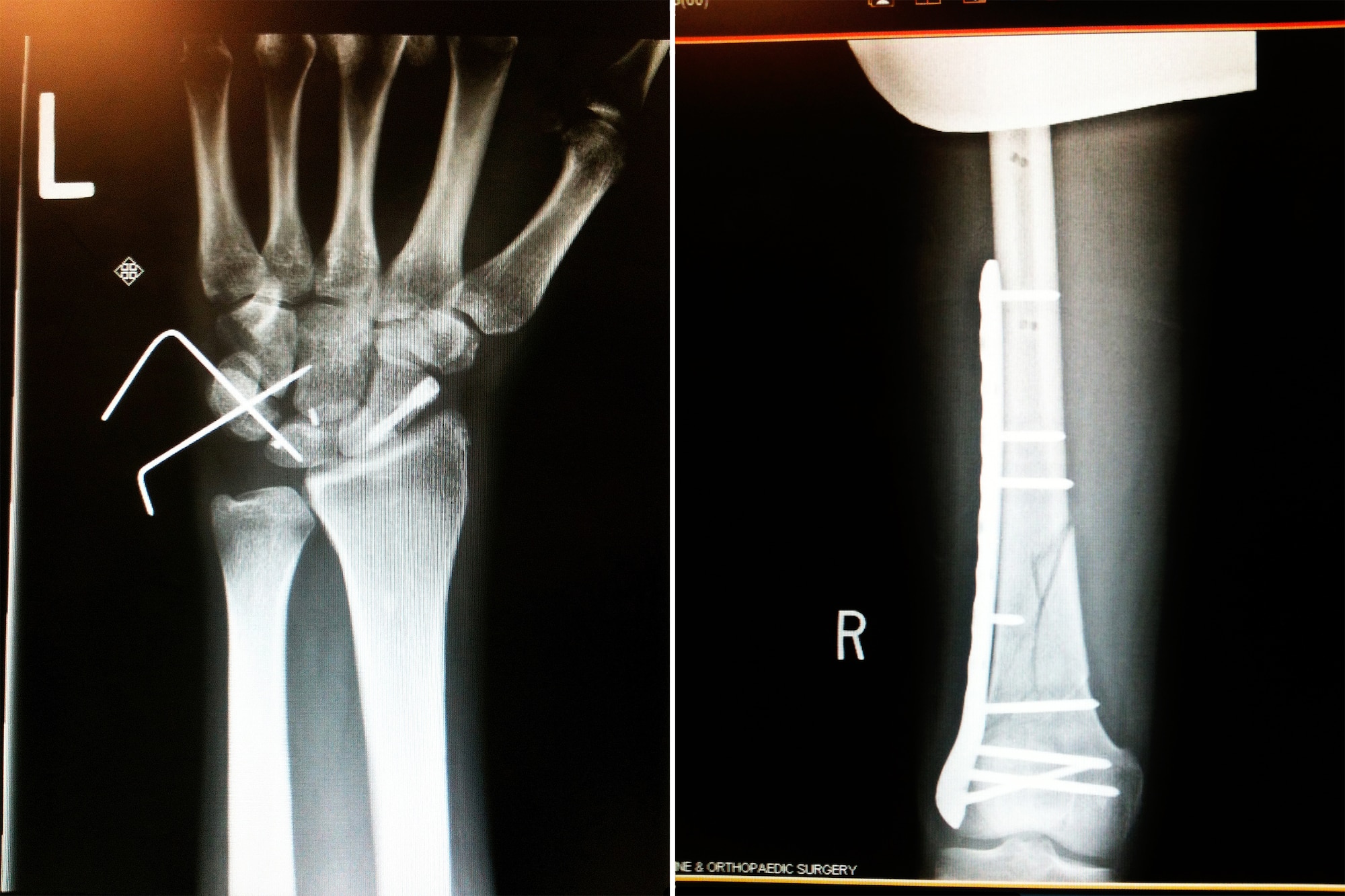 X-rays help tell the tale. Hunter fractured his left wrist, driving the broken bone into his carpal tunnel. His right femur snapped in half, and a metal plate still holds the bone together. (courtesy of Second Lt. Hunter)