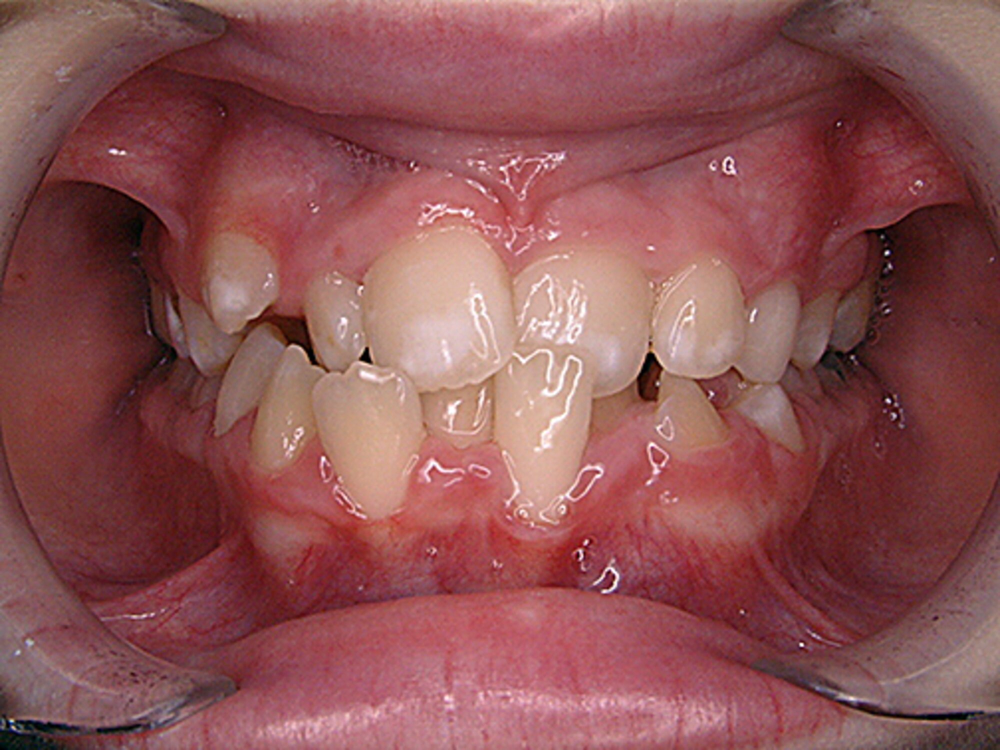 Reservists are required to be dentally ready for deployment by having a “military” dental exam once every three years. You must have “Class 3” dental conditions resolved before deployment (a dental problem likely to cause unbearable pain or swelling within one year).