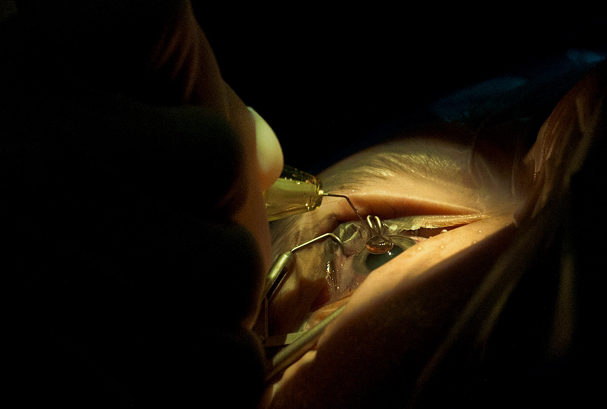 Maj. Sarah Eccles-Brown, 96th Surgical Operations Squadron, places viscoat on the eye at the start of a cataract surgery at Eglin Air Force Base, Fla.  This helps to keep the surface of the eye lubricated throughout the surgery. During the procedure, the surgeon removes the eye’s cloudy lens known as a cataract and replaces it with a new clear lens implant.  The surgery takes approximately 20 minutes.  The 96th Medical Group performs approximately 150 cataract surgeries per year.  (U.S. Air Force photo/Samuel King Jr.)
