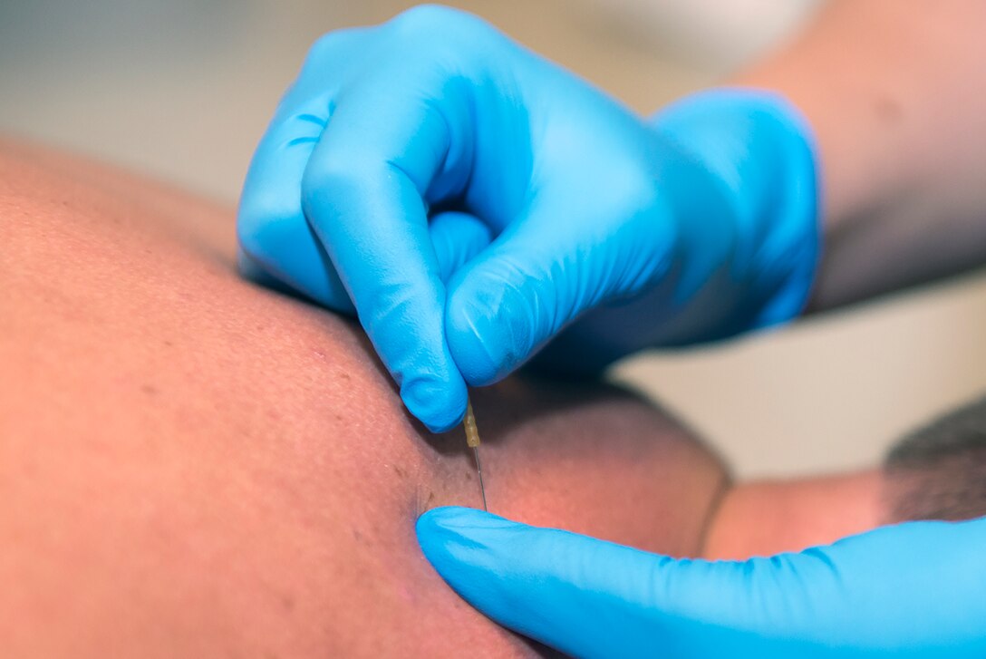 A doctor from the 23d Medical Operations Squadron clinical medicine flight performs a dry needling technique on a patient July 29, 2015, at Moody Air Force Base, Ga. Doctors needle individuals trigger points which acts as a reset button to get the problematic area to perform properly again. (U.S. Air Force photo by Airman Greg Nash/Released)