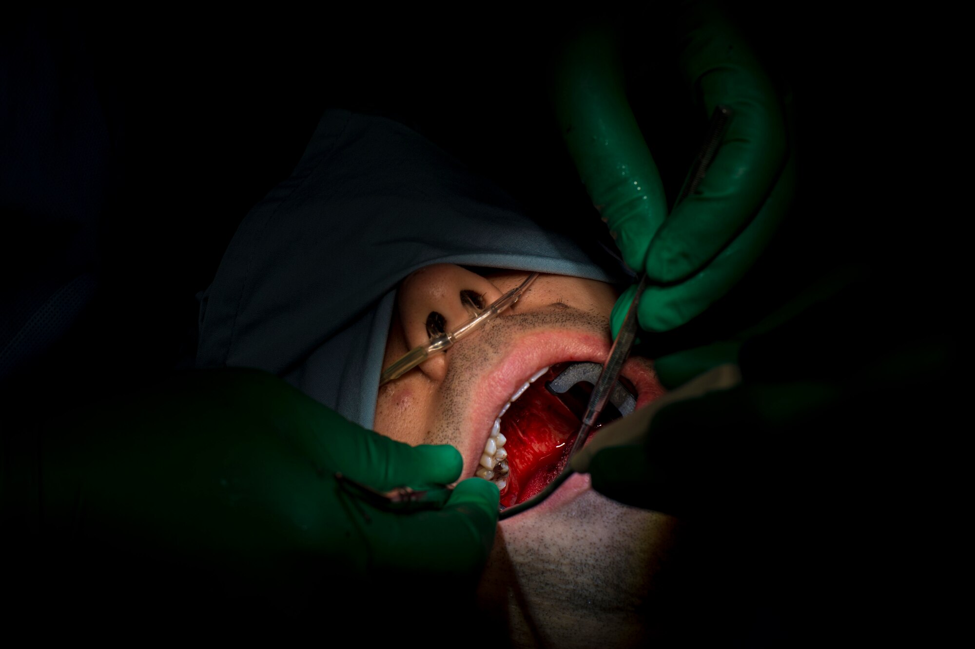 U.S. Air Force Senior Airman Jerome Javier, 354th Dental Services Flight dental technician, assists Capt. Jeremy Matis, 354th Dental Services Flight general dentist, during a surgery to remove wisdom teeth on Eielson Air Force Base, Alaska, Feb. 19, 2015 Wisdom teeth are located at the back of the mouth. They are difficult to reach to properly clean which can lead to infection and the need to remove them. (U.S. Air Force photo by Staff Sgt. Joshua Turner/Released)
