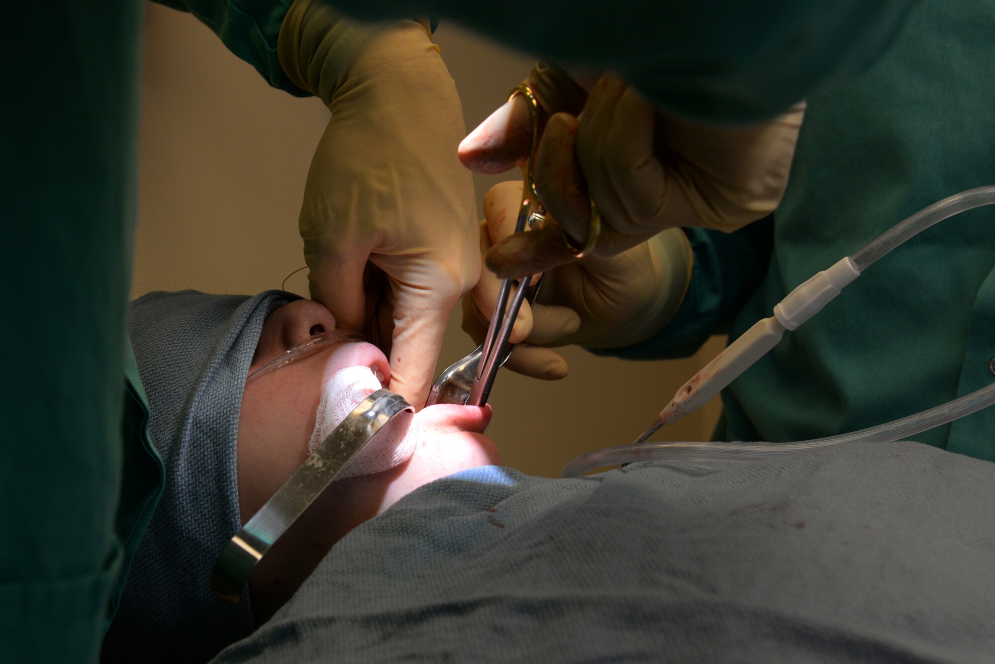 Capt. Kyle Christensen and Lisa Whisenhunt perform a wisdom teeth extraction April 8, 2015, at the Scott Clinic, Scott Air Force Base, Illinois. Wisdom teeth are extracted to correct or prevent future problems that may occur. Christensen is a General Dentist and Whisenhunt is a Dental Technician from the 375th Dental Squadron. (U.S. Air Force Photo by Airman 1st Class Megan Friedl)